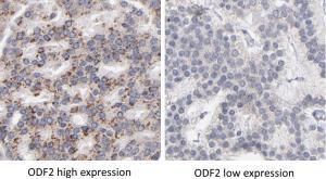 ODF2 gene high and low fig 1.jpg